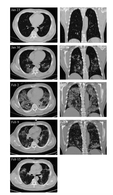 stem cells for COVID-19